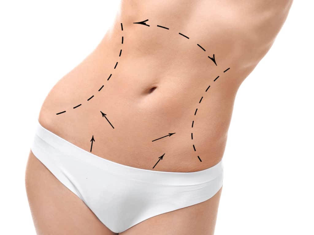 Liposuction Marketing