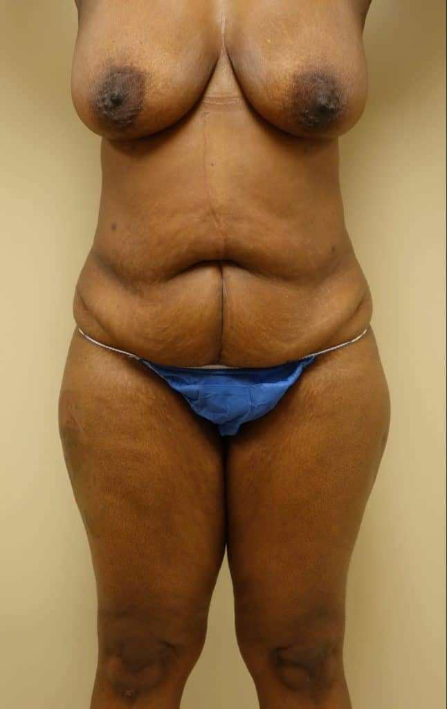 Before front