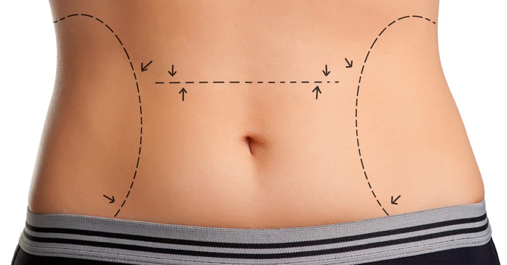 Plastic surgery procedure marks