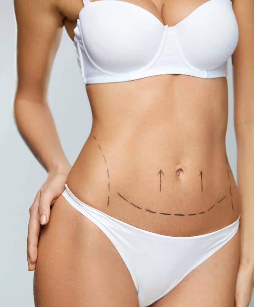 Beautiful Woman Body With Surgical Lines. Surgery Operation