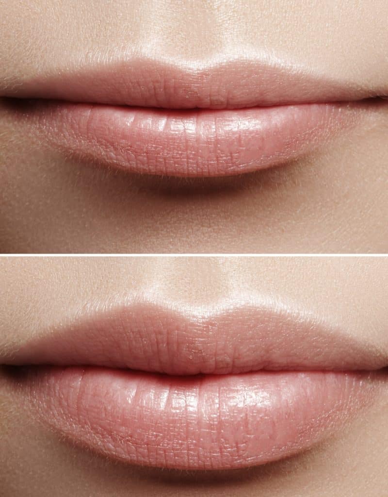 Before and after lip filler injections