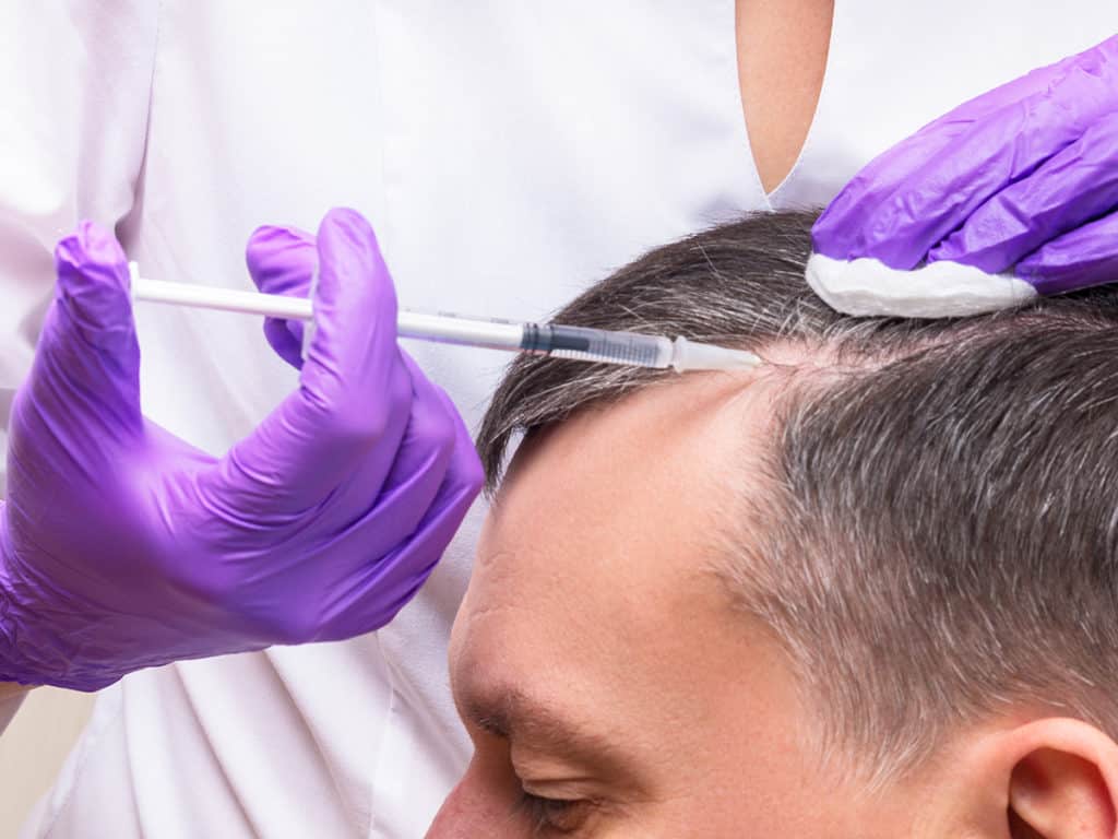 PRP Hair Restoration for men